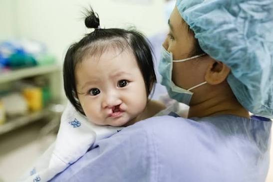 Thông tin cho trẻ em bị sứt môi hở hàm ếch có nhu cầu phẫu thuật